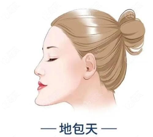 为什么骨性地包天做掩饰性正畸医生不建议？答案在这里！