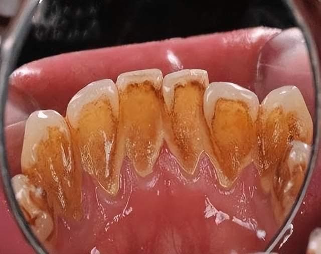 口腔健康保卫战：牙结石必知的消除技巧