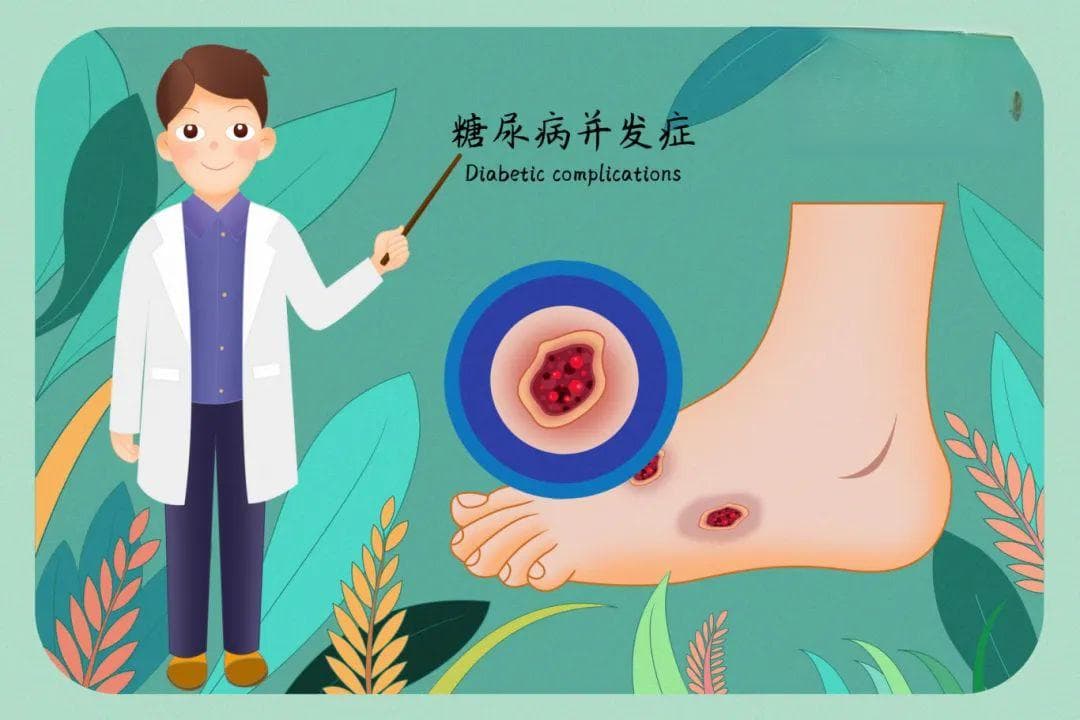 “糖友”必读：糖尿病足的预防措施