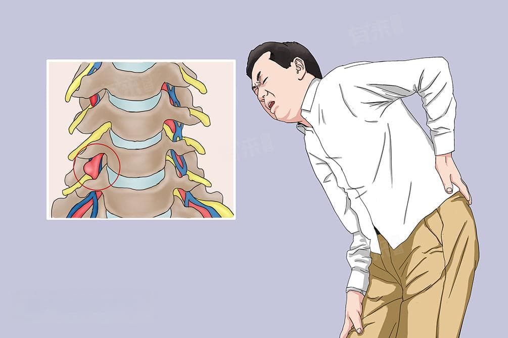 腰椎血管瘤严重吗？一文详解病因、症状与治疗方案