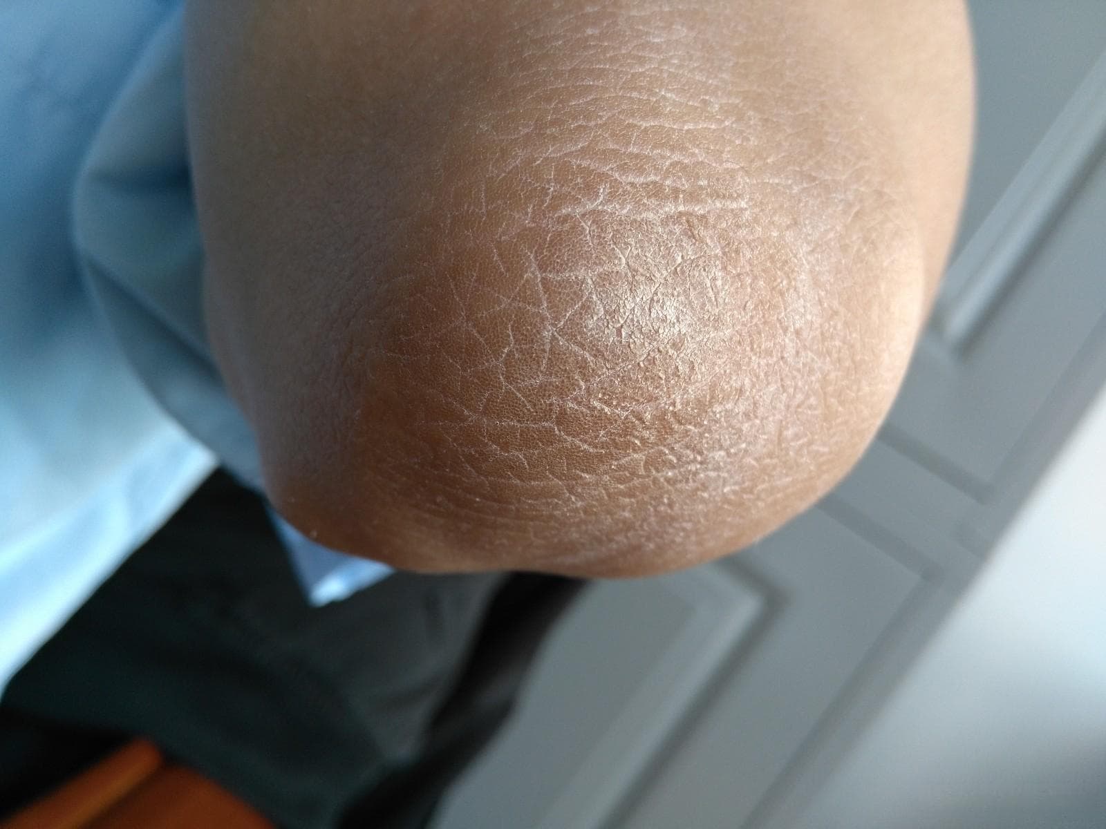 呵护肌肤，告别手肘皮肤干燥起皮——科学护理指南