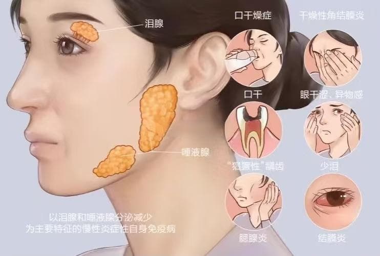 中医治疗干燥综合征