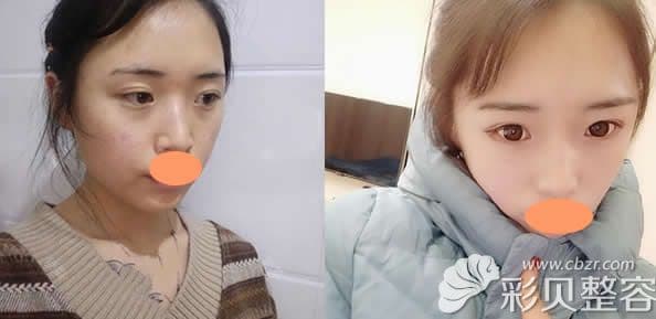 脸上痘坑做微针和点阵激光哪个好?两者区别是什么?
