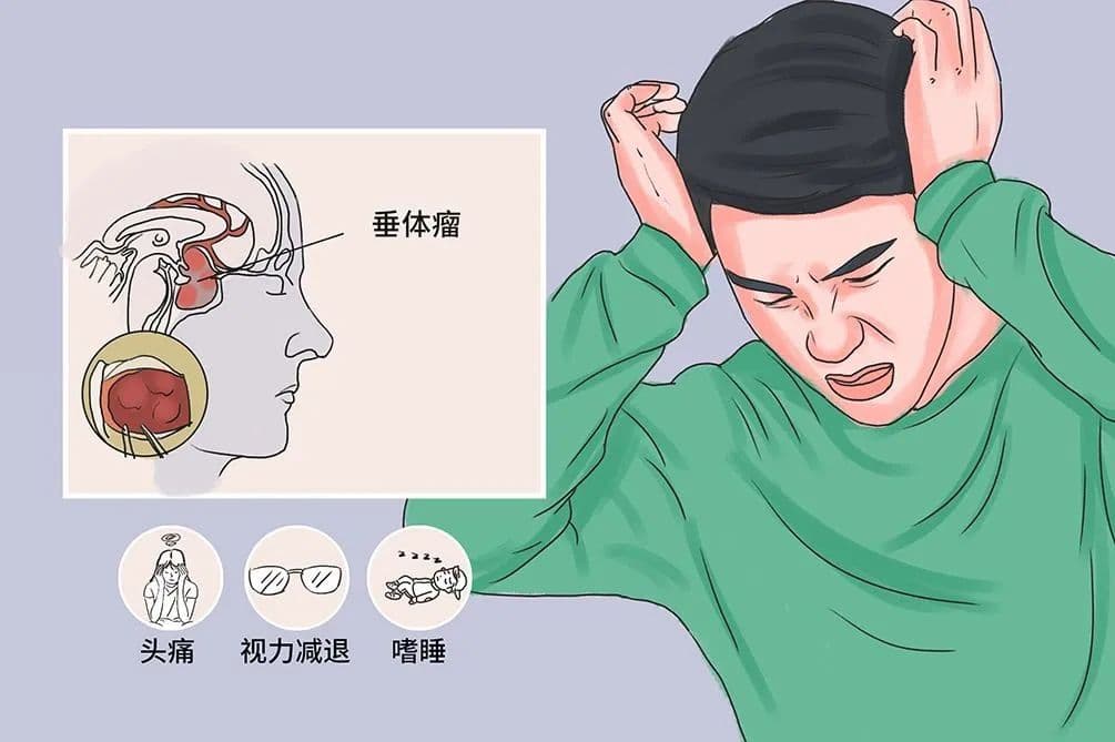中西融合治疗垂体瘤：从病因到治疗方案全解析