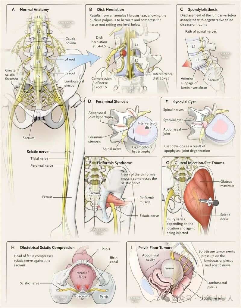 腰椎间盘突出症与梨状肌综合征的鉴别诊断