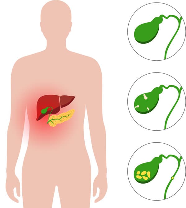 胆结石患者可以吃豆腐脑吗？专家解读
