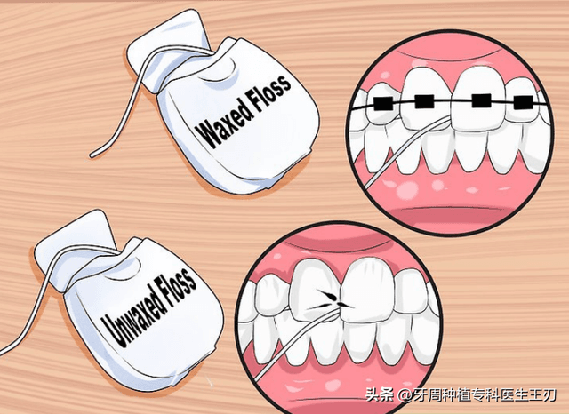 牙线、牙间隙刷（牙缝刷）和冲牙器如何选择？