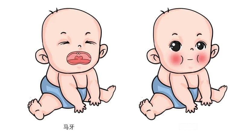新生儿"马牙"和"螳螂嘴"是怎么回事？
