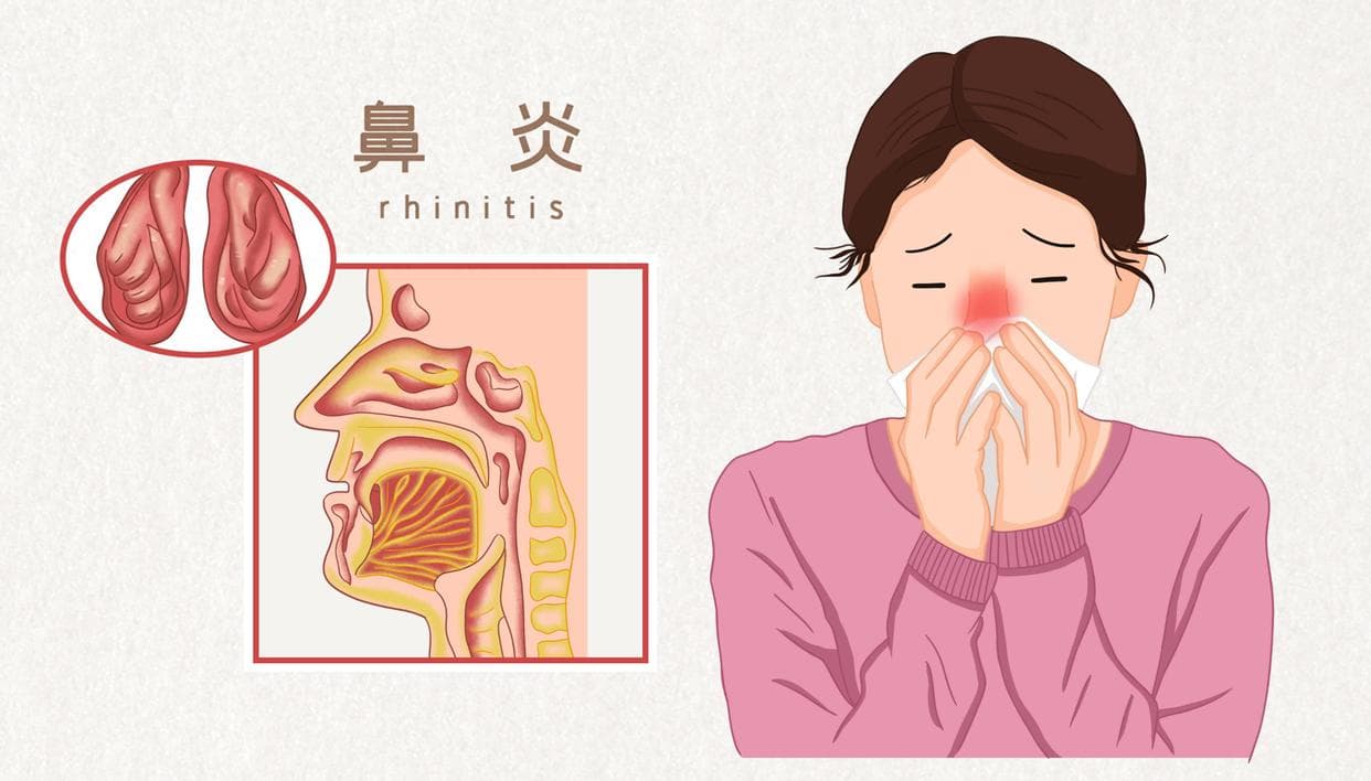 冬季过敏性鼻炎高发期，远离这些过敏原，必要时去就医！