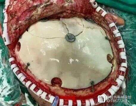 颅骨缺损的修复时机与材料选择