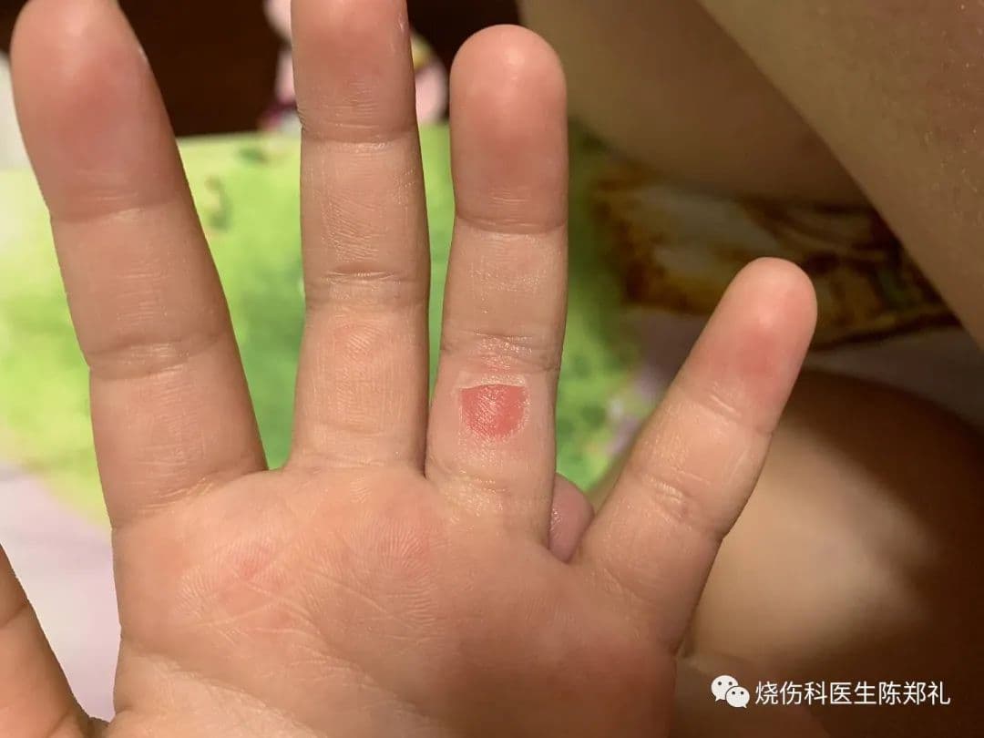 烫了水泡怎么办？医生教你正确处理方法
