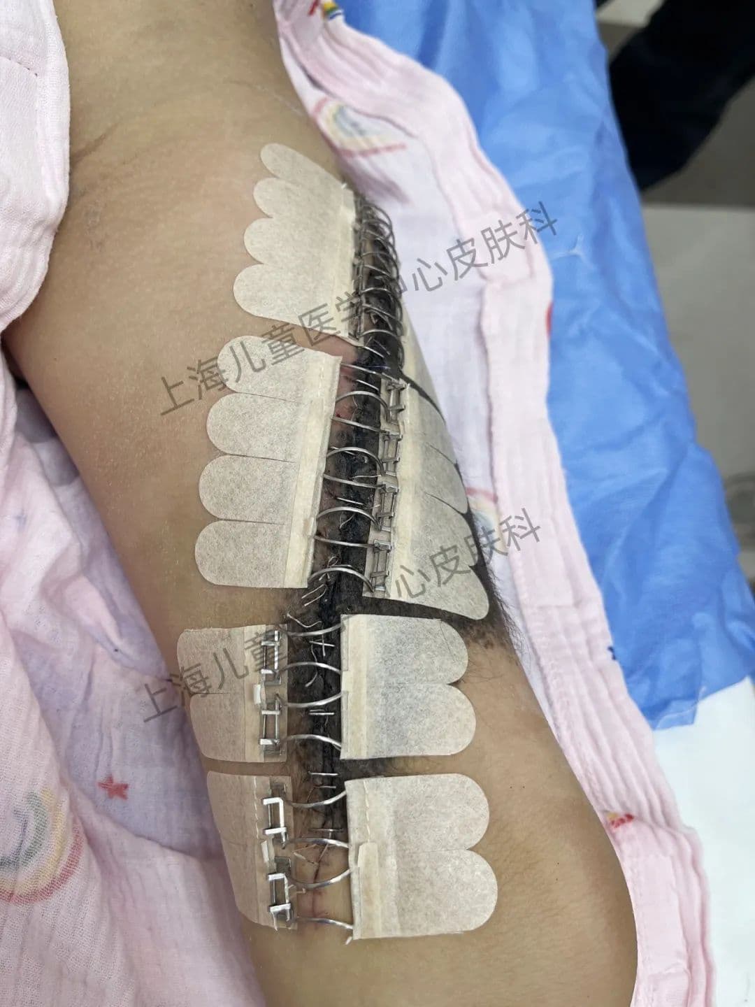 皮钉缝合技术在巨痣分次切除手术中的应用