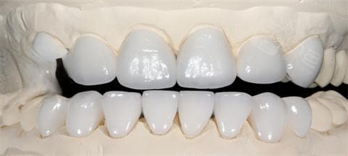 骨骼牙与全瓷牙全面对比：从材料到护理的全方位解析