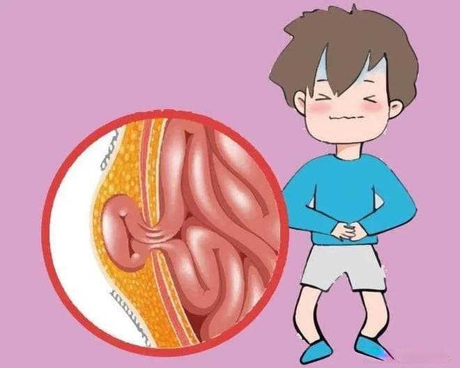 健康科普：什么是疝气？切莫大意！小心并发症！