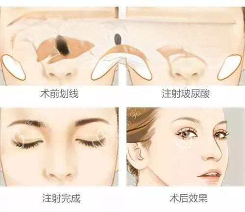 打卧蚕用胶原蛋白还是玻尿酸？材料特性/注射表现/维持时间多角度对比