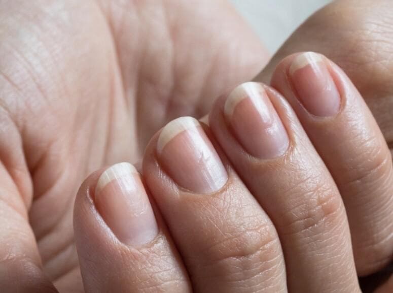 指甲顏色外觀怎樣才算健康？ 指甲也能揭示身體毛病