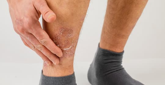 苯佐卡因（Benzocaine）：功效、副作用、注意事项及禁忌人群