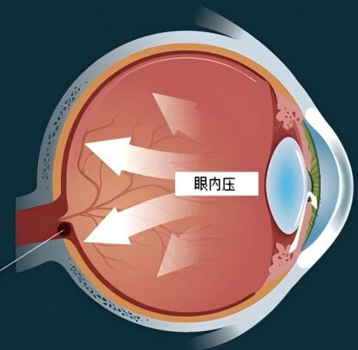 细说眼压：正常眼压的范围？眼压未必是引发青光眼的元凶？