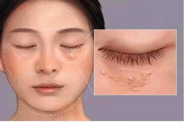 汗管瘤，不要怕！