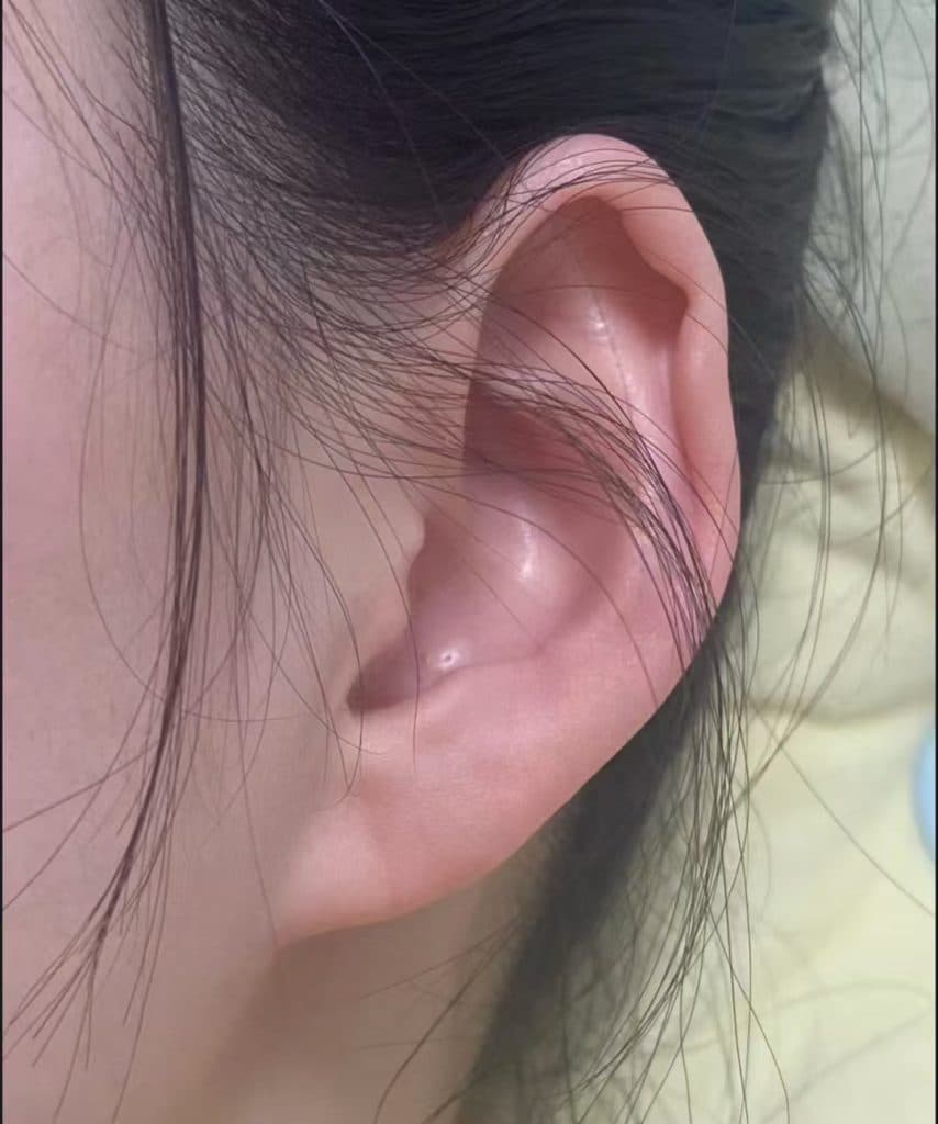 耳部折痕解决方案全攻略
