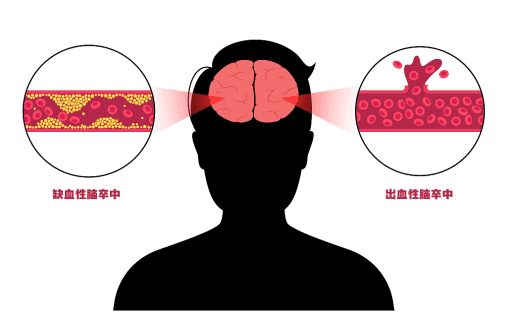 小心！脑梗在春季多发！如何及早识别与急救？专家提醒→