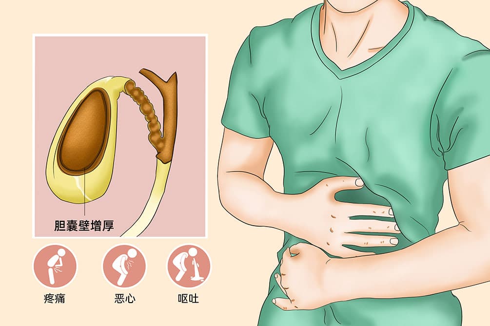 胆囊壁增厚：病因、症状与治疗全解析