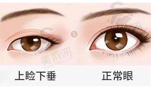 上睑下垂手术和双眼皮手术的区别：恢复期、保持期差异大起底