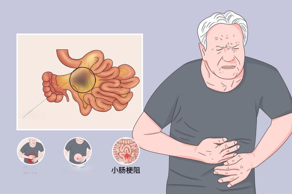 肠系膜脂膜炎