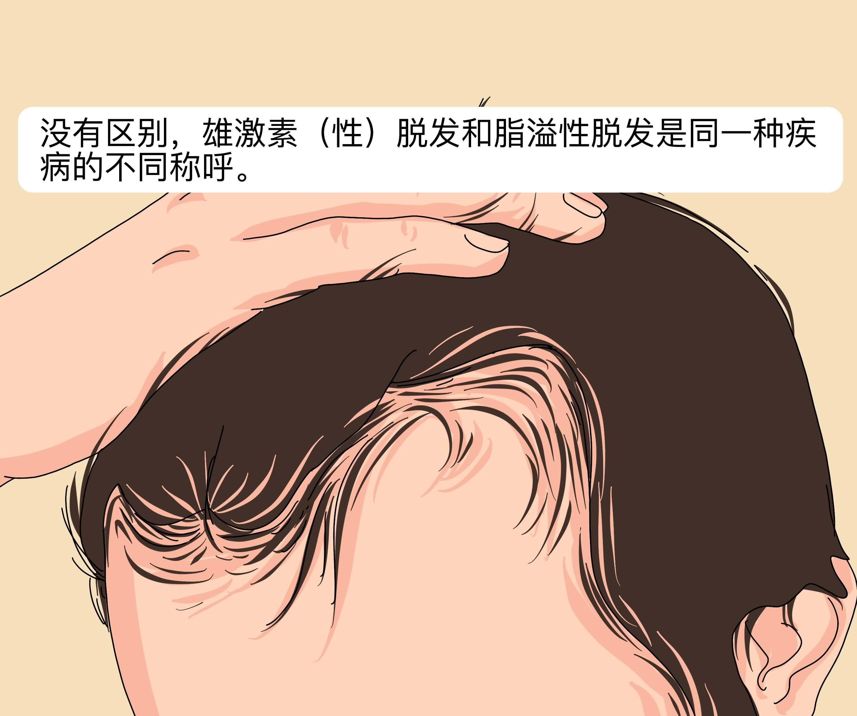 雄激素脱发和脂溢性脱发有区别吗