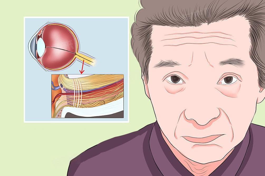 视觉神经萎缩治疗：从药物到手术的全方位指南