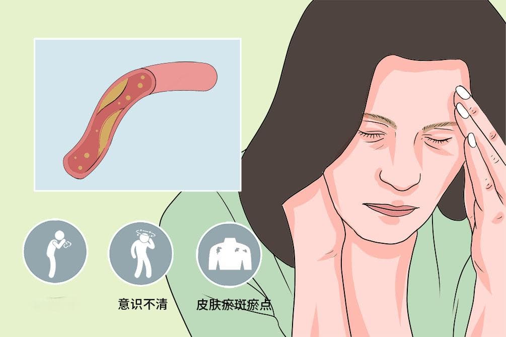 脂肪栓塞综合征