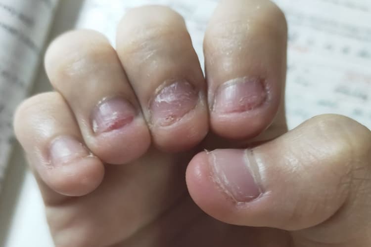啃手指甲是什么毛病？从医学角度解析咬甲癖