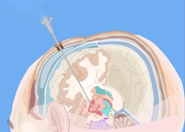 颞叶白质病变：病因、症状、检查、治疗与护理全解析