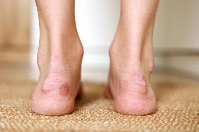 脚上长的是鸡眼、瘊子，还是老茧，你搞清楚了吗？了解一下