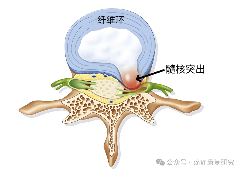 腰痛不可忽视的疾病：第三腰椎横突综合征