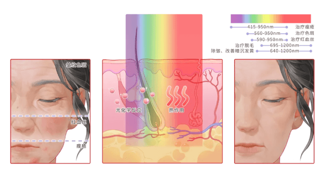 医美大盘点 | 告别暗沉和色斑！光子嫩肤：医美界的“超级英雄”