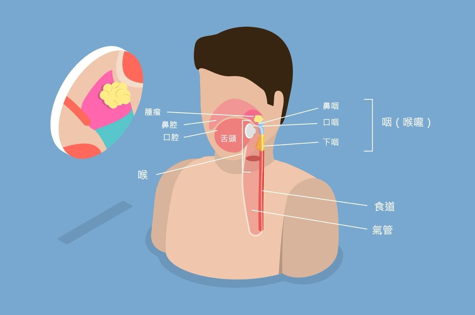 揭秘「广东癌」真相：鼻咽癌为何在此高发？症状与治疗全解析