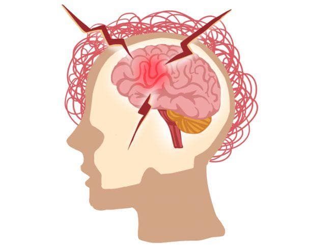精神分裂症患者自知力：判断标准与恢复方法