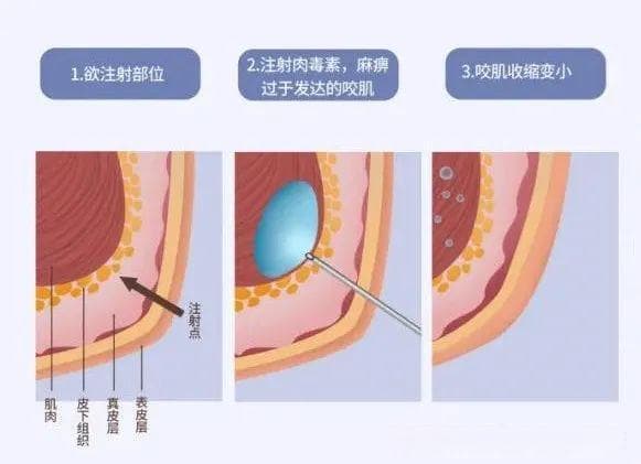 整形医生解析：瘦脸针的原理、注射过程及注意事项
