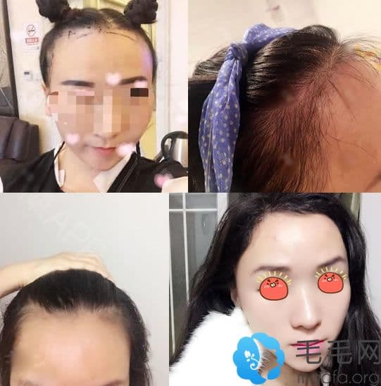 米诺地尔副作用全解析：使用后长红点怎么办？