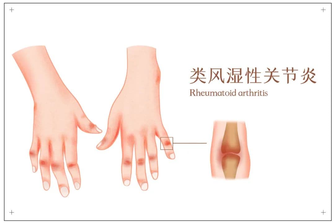 一文读懂类风湿性关节炎：病因、治疗与生活指南