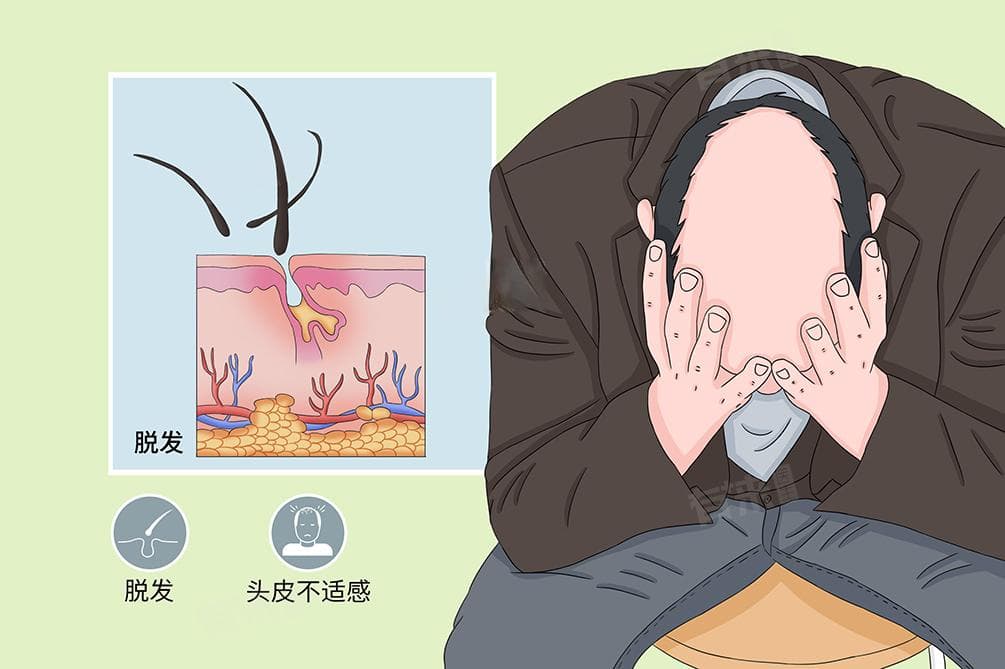 鬼剃头（斑秃）的治疗方法及症状表现