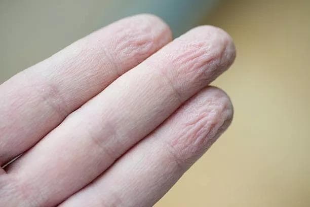 春天到了，你家宝宝手脱皮了吗？你手脱皮了吗？