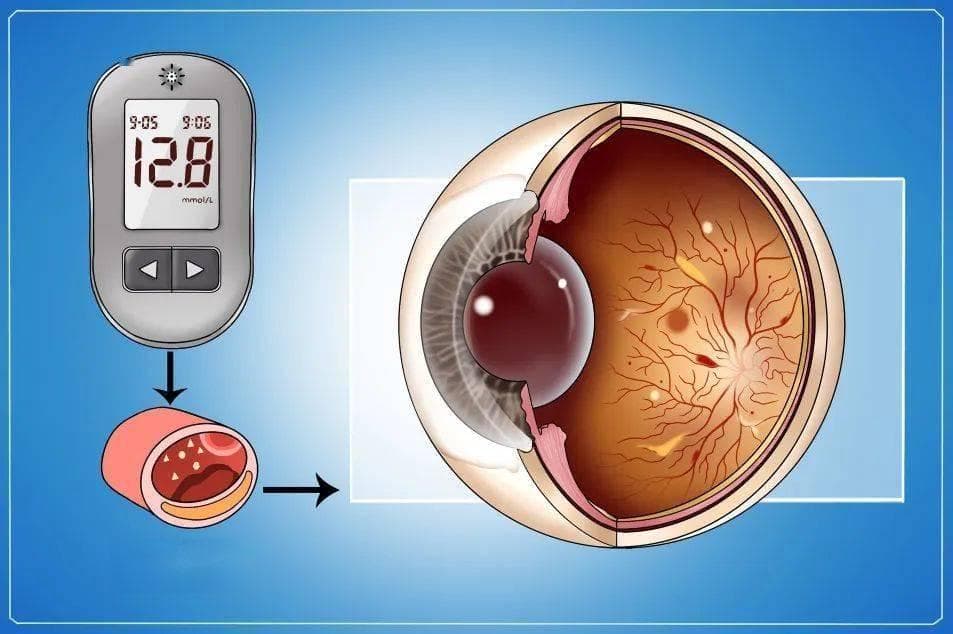 【Eyenurse.科普】眼睛的求救信号：内科疾病的眼部表现