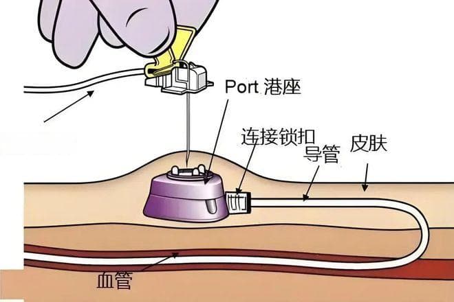 一种更“体贴”的输液方式——“输液港”