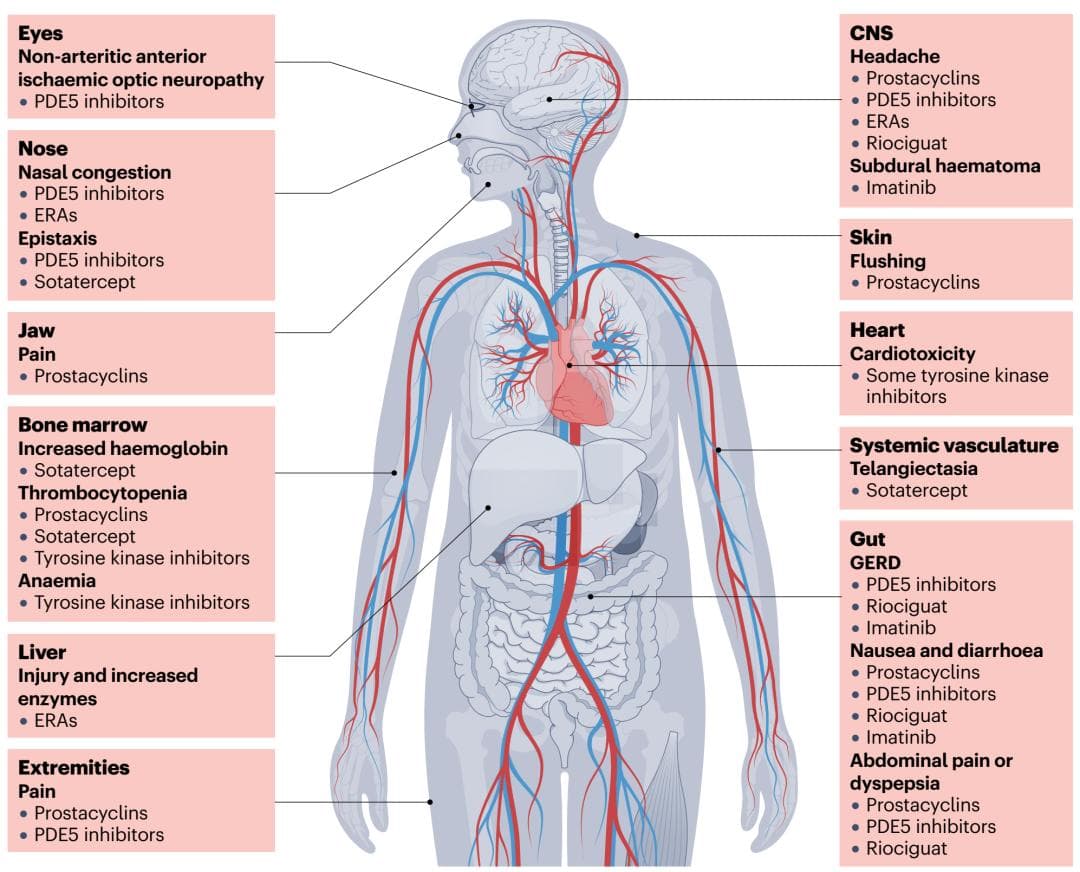Nat Rev Cardiol：2024年最新肺动脉高压治疗方案汇总及其局限性
