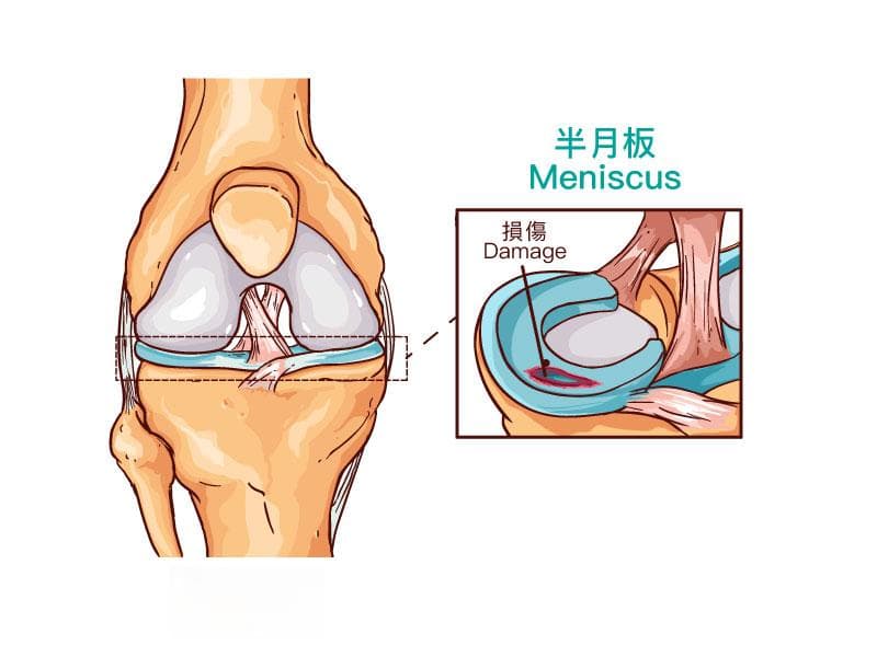 膝关节半月板修复手术详解：从病因到术后护理