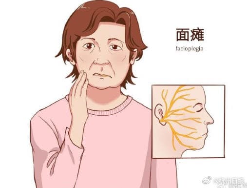 面部受风寒，女子口角歪斜！医生提醒：这些因素易引发“面瘫”