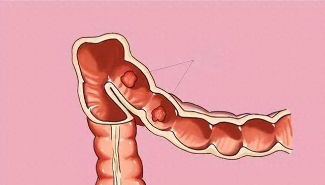肠息肉科普：从筛查到预防，全面了解肠道健康隐患