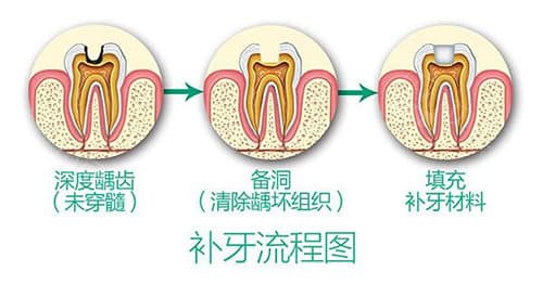 武汉补牙可以用统筹账户吗？是统筹范围内项目可以使用统筹账户支付！但必须是定点牙科